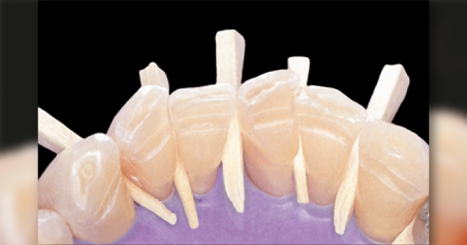 TÉCNICA DE USO - Contenção periodontal
