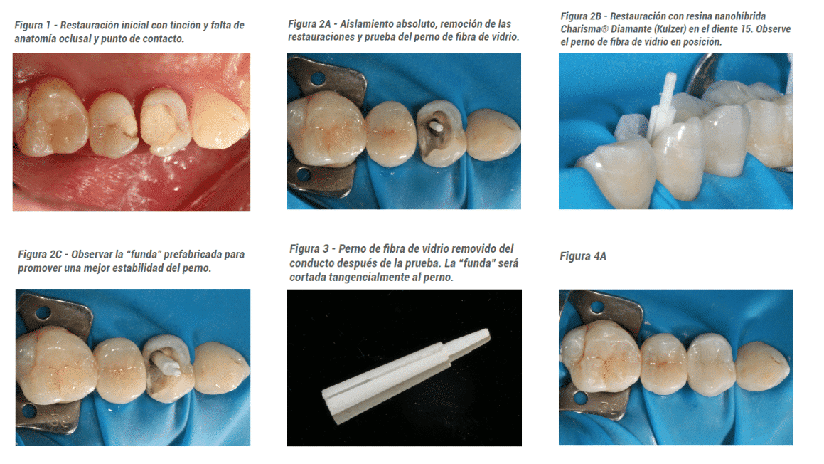 Restauración De Dientes Posteriores: Resina Compuesta Directa En ...